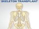 Skeleton transplant